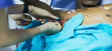 A Closer Look at Chest Tubes
